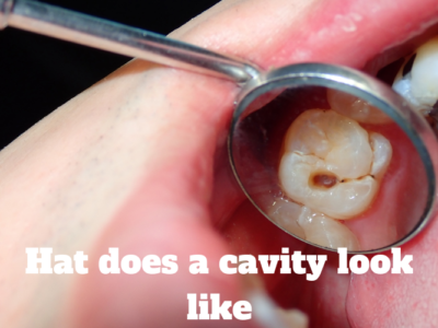 Hat does a cavity look like