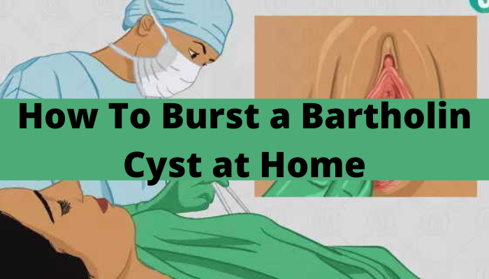 How to burst a bartholin cyst at home