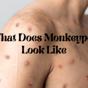 What does monkeypox look like